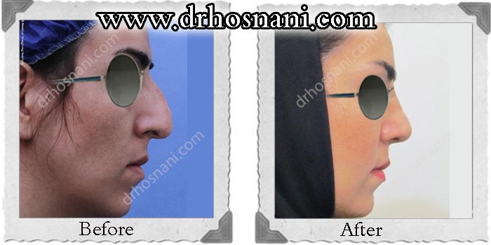 nose_surgery_125.jpg