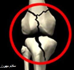 داروهای ایجاد کننده پوکی استخوان داروهای ایجاد کننده پوکی استخوان