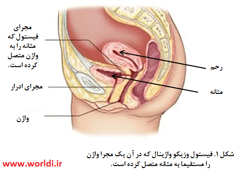 باز شدن مثانه به واژن