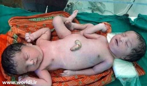 تصاویر تولد دوقلوهای به هم چسبیده با یک کمر و 2 سر