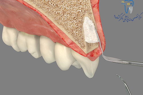  محافظت از ستیغ استخوان فک پس از کشیدن دندان