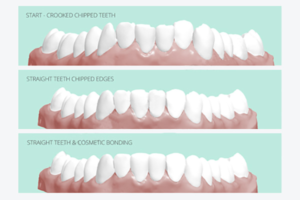 اصلاح سه ویژگی مهم دندان برای زیباتر کردن لبخند