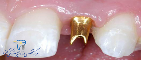 اباتمنت دندان چیست؟