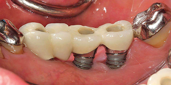 عفونت اطراف ایمپلنت دندان
