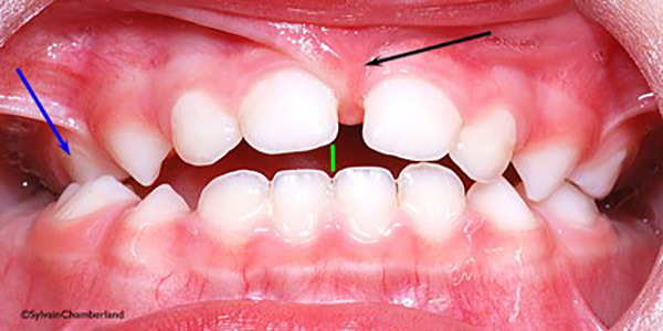 آیا پستانک برای دندانهای کودک مشکل ایجاد میکند؟ 