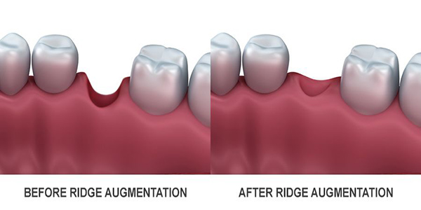 بزرگ کردن ستیغ فک پیش از کاشت ایمپلنت دندان