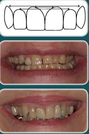  طراحی لبخند توسط دندانپزشک متخصص ترمیمی و زیبایی دندان