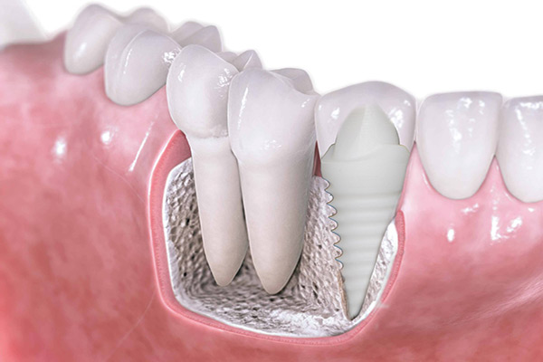  فواید و مزیتهای ایمپلنت دندان زیرکونیا