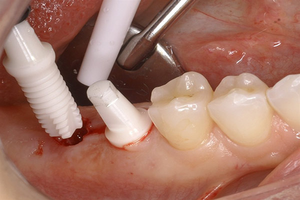 فواید و مزیتهای ایمپلنت دندان زیرکونیا