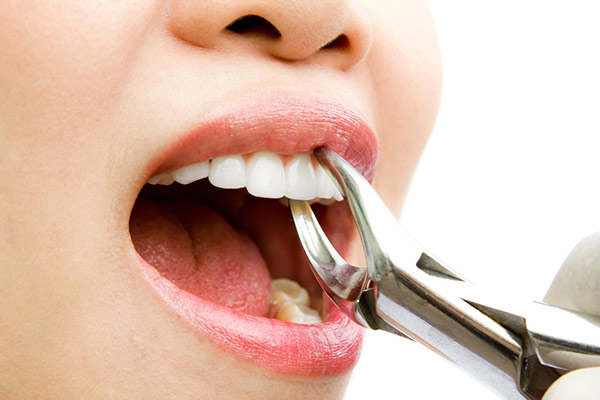 دلایل کشیدن دندان چیست؟