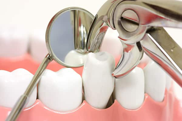 کشیدن دندان چگونه است؟آیا میتوان همزمان با کشیدن ایمپلنت کاشت؟
