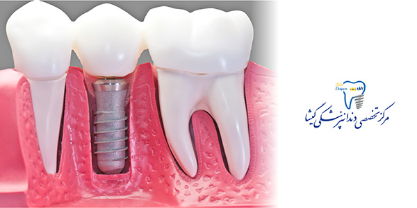مراحل کاشت ایمپلنت دندان توسط متخصص ایمپلنت در تهران