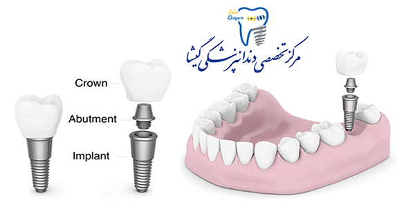  جراحی کاشت ایمپلنت دندان توسط فوق تخصص ایمپلنت در تهران