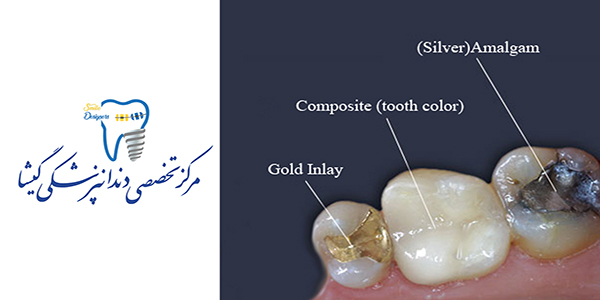 مقایسه آمالگام و کامپوزیت برای ترمیم دندان