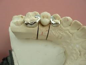  بریج مریلند توسط متخصص پروتز های دندانی و ایمپلنت در تهران