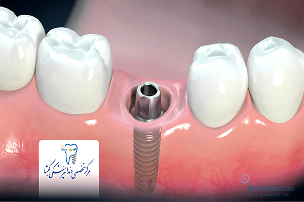 مراحل جایگزینی ایمپلنت دندان