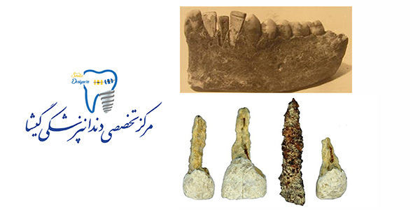 تاریخچه ایمپلنت دندان