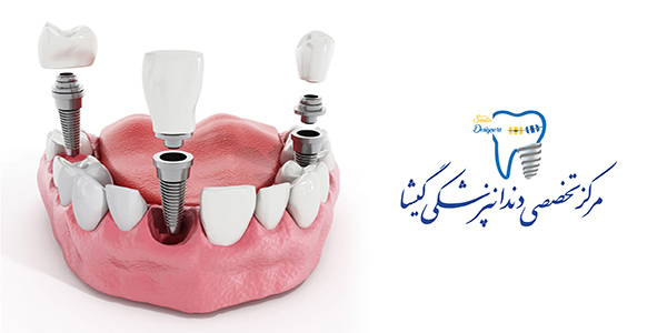 مزیتهای ایمپلنت(کاشت دندان) بر بریج و دندان مصنوعی متحرک
