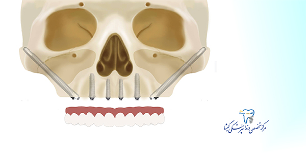 جنس ایمپلنت دندان
