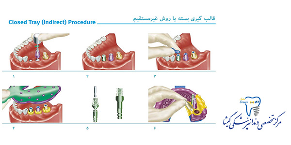 روشهای قالب گیری ایمپلنت توسط متخصص پروتزهای دندانی و ایمپلنت در تهران