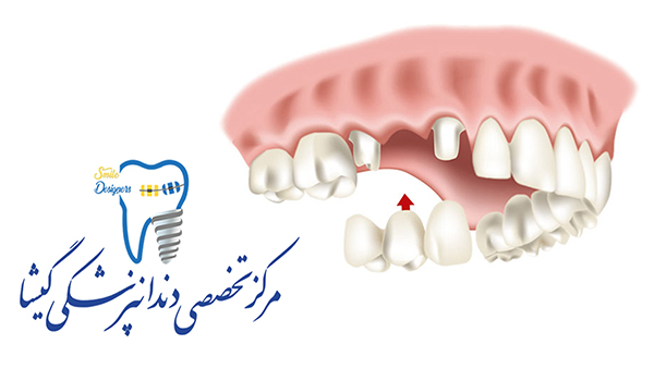 دندان مصنوعی کامل توسط متخصص پروتزهای دندانی وایمپلنت در تهران
