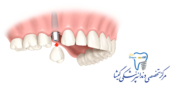 نکات مهم در کاشت ایمپلنت دندان از نظر متخصص ایمپلنت در تهران