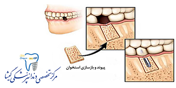 پیوند استخوان برای کاشت ایمپلنت دندان توسط متخصص ایمپلنت در تهران