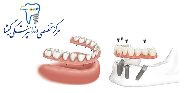  پروتز ثابت متکی بر ایمپلنت های دندانی توسط متخصص ایمپلنت در تهران