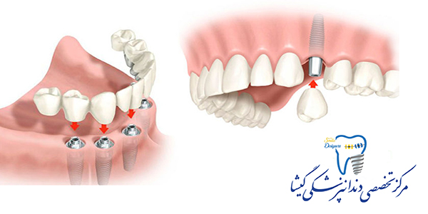  پروتز ثابت متکی بر ایمپلنت های دندانی توسط متخصص ایمپلنت در تهران