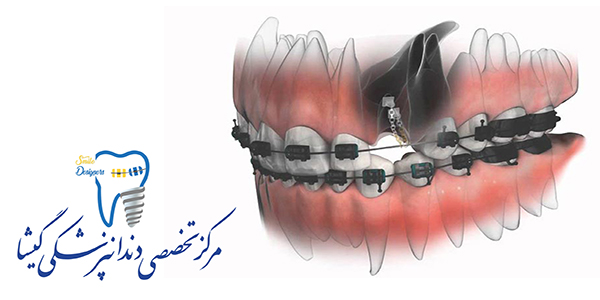  درمان ارتودنسی دندان نهفته توسط متخصص ارتودنسی