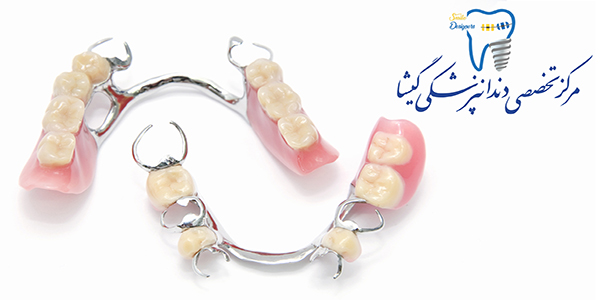 پروتز پارسیل ( تیکه ای) توسط متخصص پروتزهای دندانی وایمپلنت در تهران
