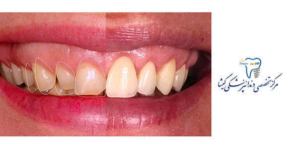 لبخند لثه ای و درمان آن توسط متخصص زیبایی دندان در تهران