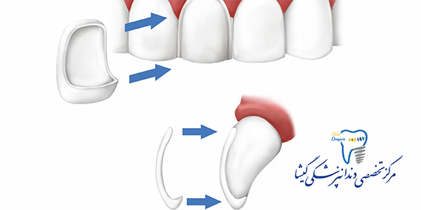 لامینیت سرامیکی توسط متخصص پروتزهای دندانی و ایمپلنت در تهران