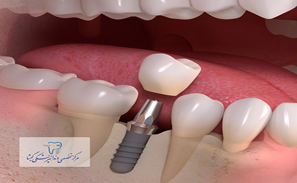ایمپلنت دندان و روکش یک روزه توسط بهترین متخصص ایمپلنت دندان درغرب تهران