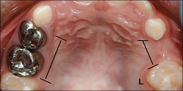 عوارض و مشکلات ارتودنسی از دست دادن دندان شیری