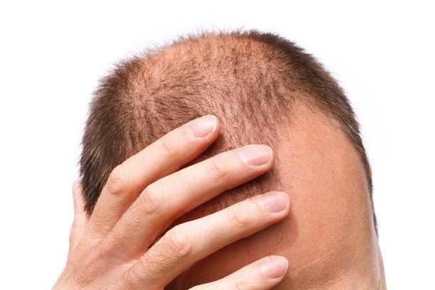 باید و نبایدهای روغن جلوگیری از ریزش مو 