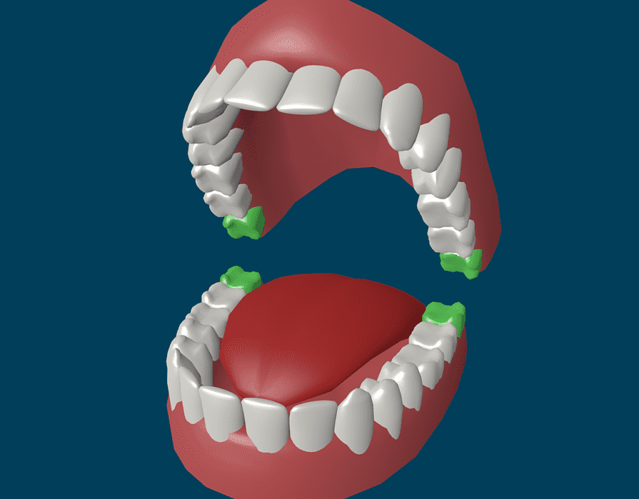 دندان عقل - جویابیست