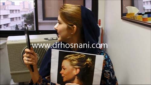 نتیجه جراحی بینی با دکتر حسنانی
